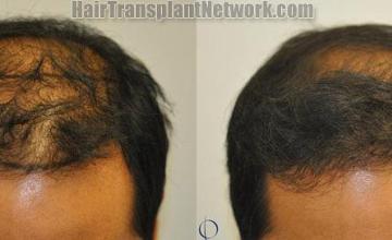 Hair transplantation surgery before and after photos