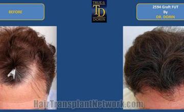 Hair transplantation surgery before and after photos