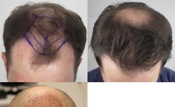 Hair transplantation surgery before and after photos