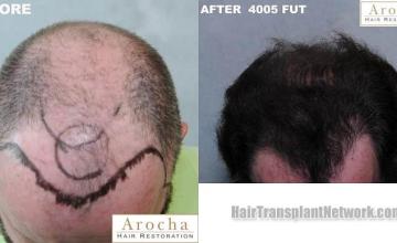 Top view - Before and after surgical hair replacement