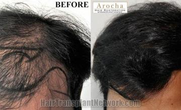 Hair restoration procedure before and after results