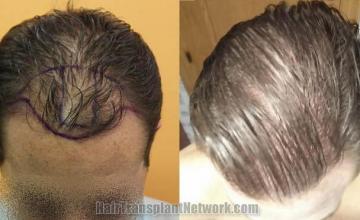 Hair transplantation surgery before and after photos