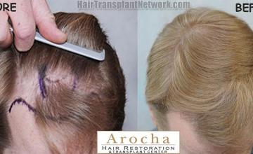 Hair restoration procedure before and after results