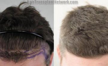 Hair transplantation surgery before and after photos