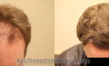 Hair restoration procedure before and after result photos