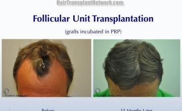 Surgical hair transplantation result photographs