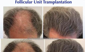 Hair transplantation surgery before and after images