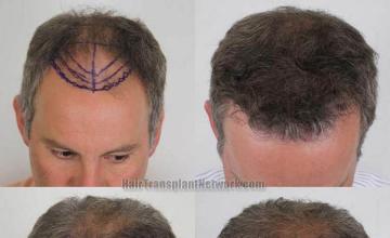 Hair transplantation surgery before and after photos