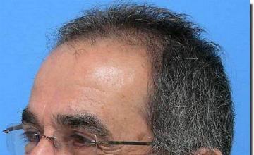 Hair restoration procedure results