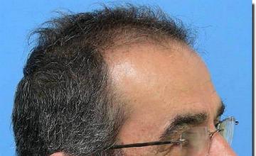 Hair restoration procedure results