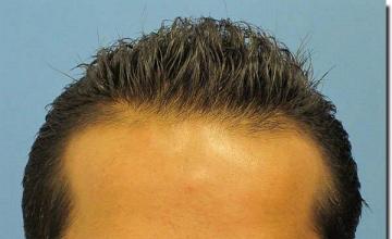 Hair restoration procedure results