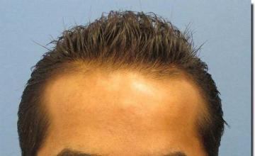 Hair restoration procedure results