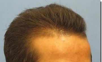 Hair restoration procedure results