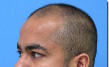 Hair restoration procedure results