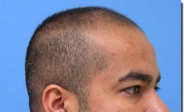 Hair restoration procedure results