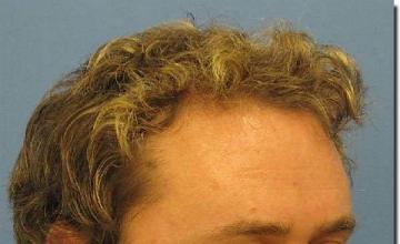 Hair restoration procedure results