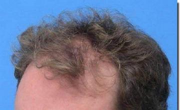 Hair restoration procedure results