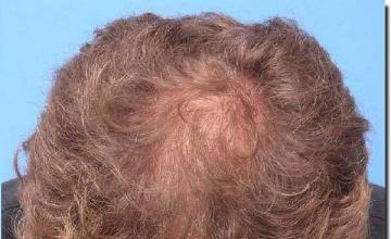 Hair restoration procedure results