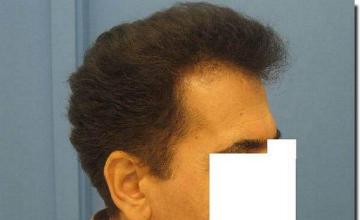 Hair restoration procedure results