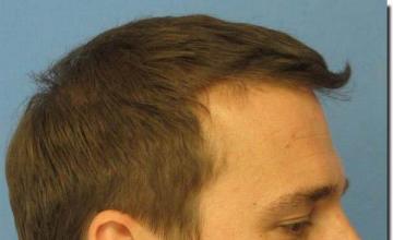 Hair restoration procedure results