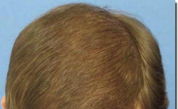 Hair restoration procedure results