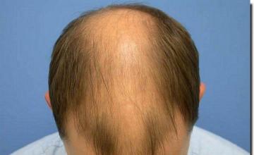 Hair restoration procedure results