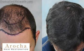 Hair transplantation surgery before and after photos