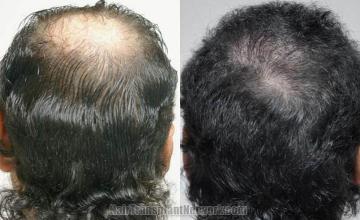 Back view before and after hair transplantation photos