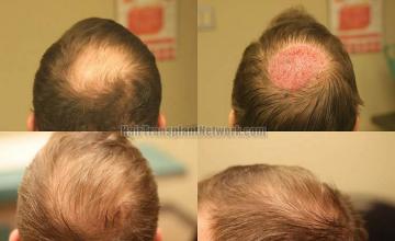 Hair restoration procedure before and after results