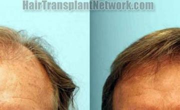 Hair transplantation surgery before and after photos