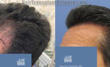 Hair transplantation surgery before and after pictures