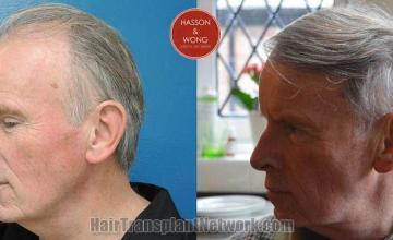 Hair transplantation surgery before and after images