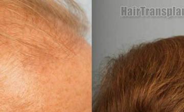 Hair transplantation surgery before and after pictures