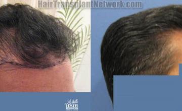 Hair transplantation surgery before and after images