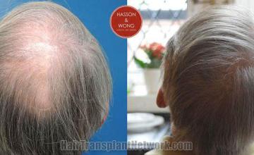 Hair restoration procedure before and after pictures