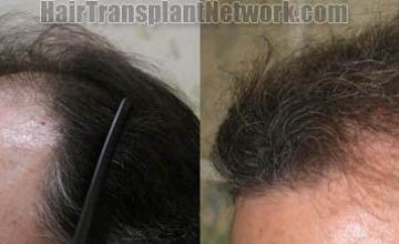 Hair restoration procedure before and after pictures