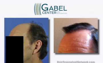 Hair transplantation surgery before and after pictures