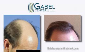 Hair transplantation surgery before and after images