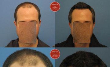 Hair restoration procedure before and after results