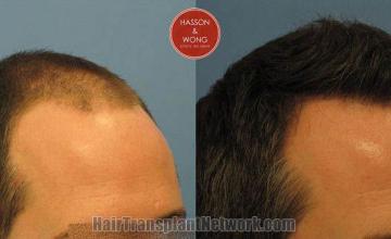 Hair transplantation surgery before and after images