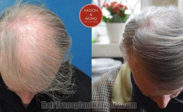 Hair transplantation surgery before and after photos