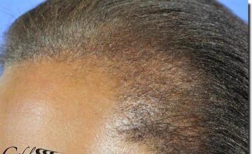 Hair restoration procedure results