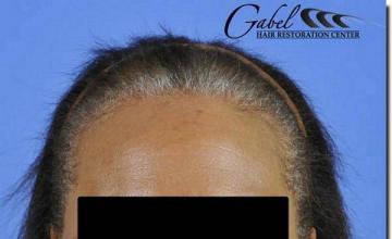 Hair restoration procedure results