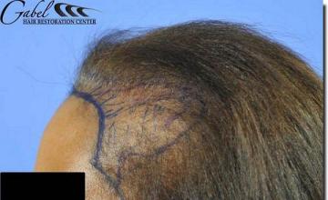 Hair restoration procedure results