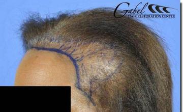 Hair restoration procedure results