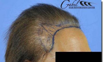 Hair restoration procedure results