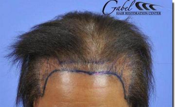 Hair restoration procedure results