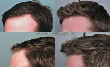 Hair transplantation surgery before and after photos