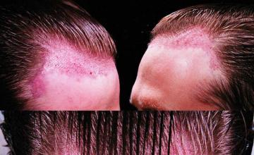 Surgical hair transplantation result photographs