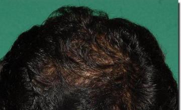 Hair restoration procedure results